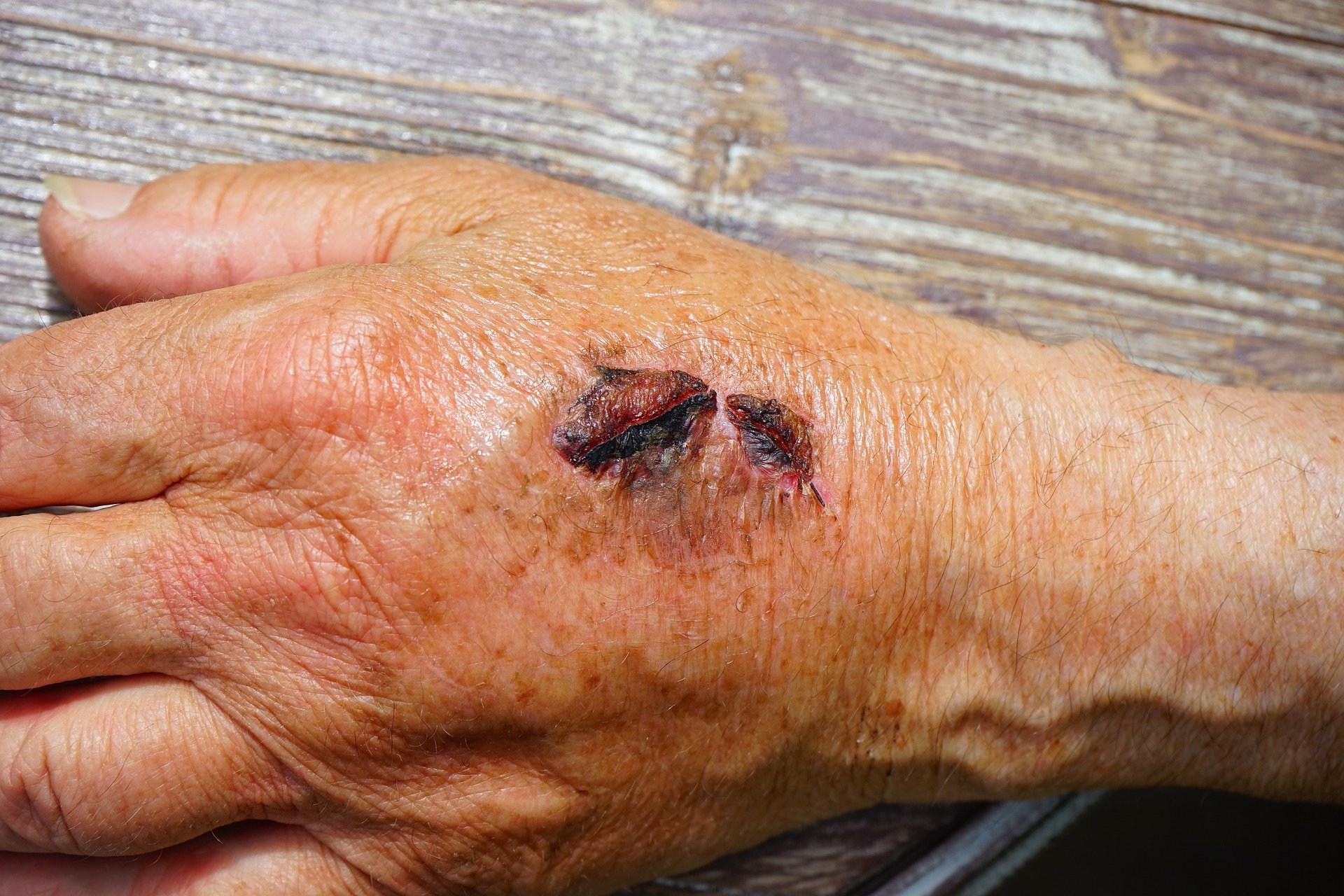 Wound care | SoftWave Therapies Ohio